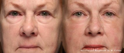 AccuTite Skin Tightening Before & After Case 42