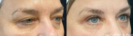AccuTite Skin Tightening Before & After Case 45