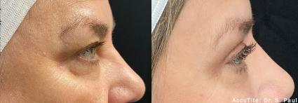 AccuTite Skin Tightening Before & After Case 45 - 2