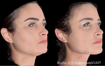 AccuTite Skin Tightening Before & After Case 46