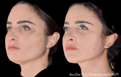 AccuTite Skin Tightening Before & After Case 46 - 2