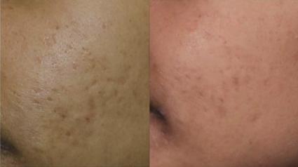 Pixel RF Before & After Case 26 - 2