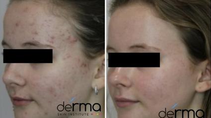 Acne Treatment By Dr. Sajic Before & After Case 9