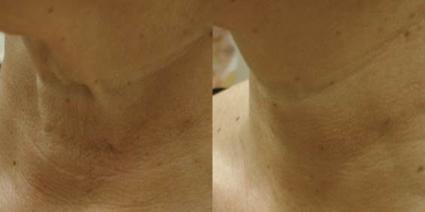 ClearLift Before & After Case 34