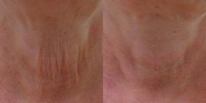 ClearLift Before & After Case 36