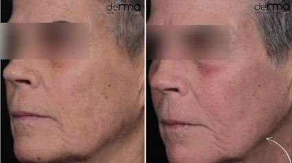 Dr. Sajic's 5 Dimension Skin Plan™ Before & After Case 20