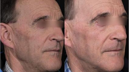 Dr. Sajic's 5 Dimension Skin Plan™ Before & After Case 24