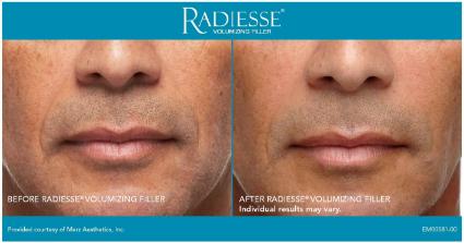 Radiesse® Before & After Case 47
