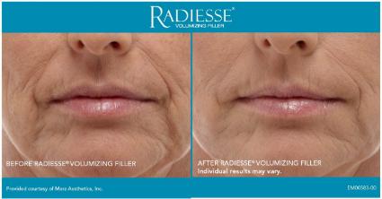 Radiesse® Before & After Case 48