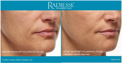 Radiesse® Before & After Case 50