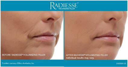 Radiesse® Before & After Case 52