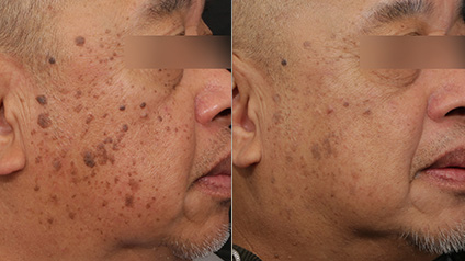 Dr. Sajic's Fraxel Before & After Case 29